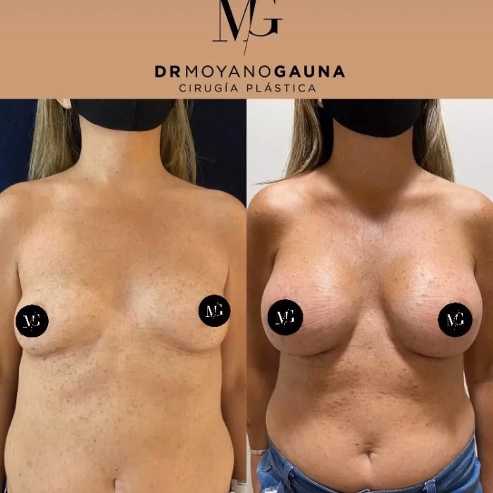 ¿Quiénes son los mejores cirujanos de mamas en Chile?