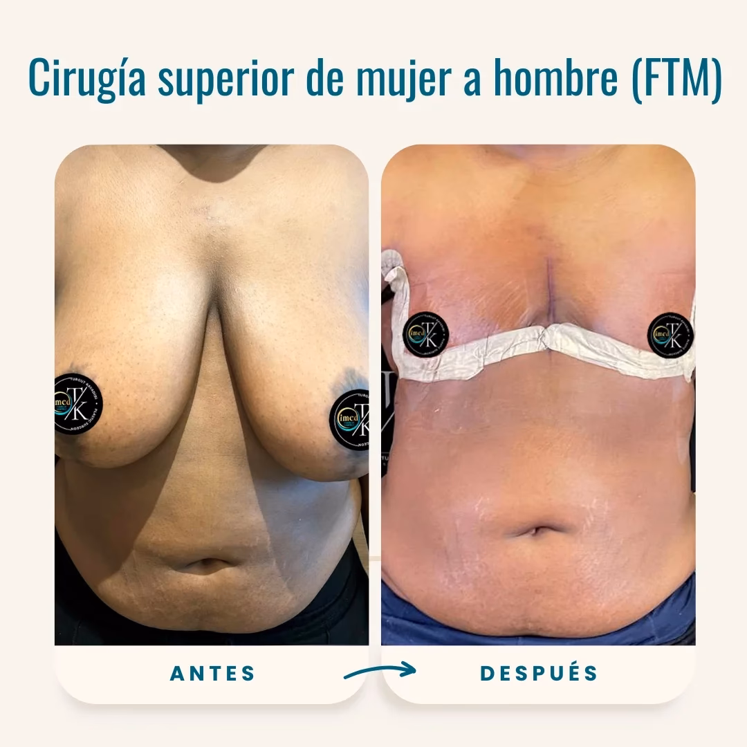 ¿Qué hormona hace que crezcan los senos en hombres?