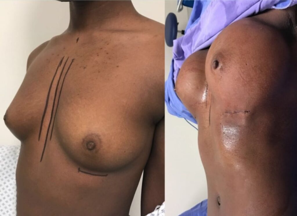 Costo de una Mastopexia: Guía Completa de Precios