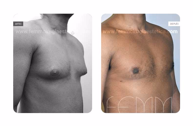 Costo de la Ginecomastia: Guía Completa 2024