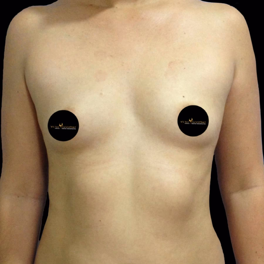 ¿Cuánto cuesta una cirugía de senos en Ecuador?