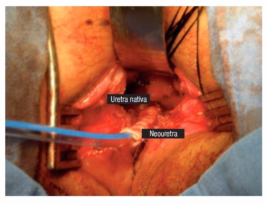 ¿Cómo es una operación de la uretra?