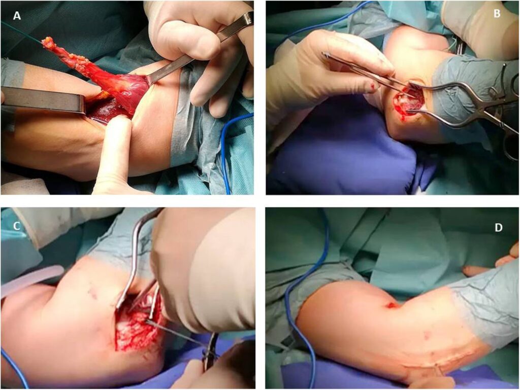 Reparación del Tendón Distal del Bíceps: Guía