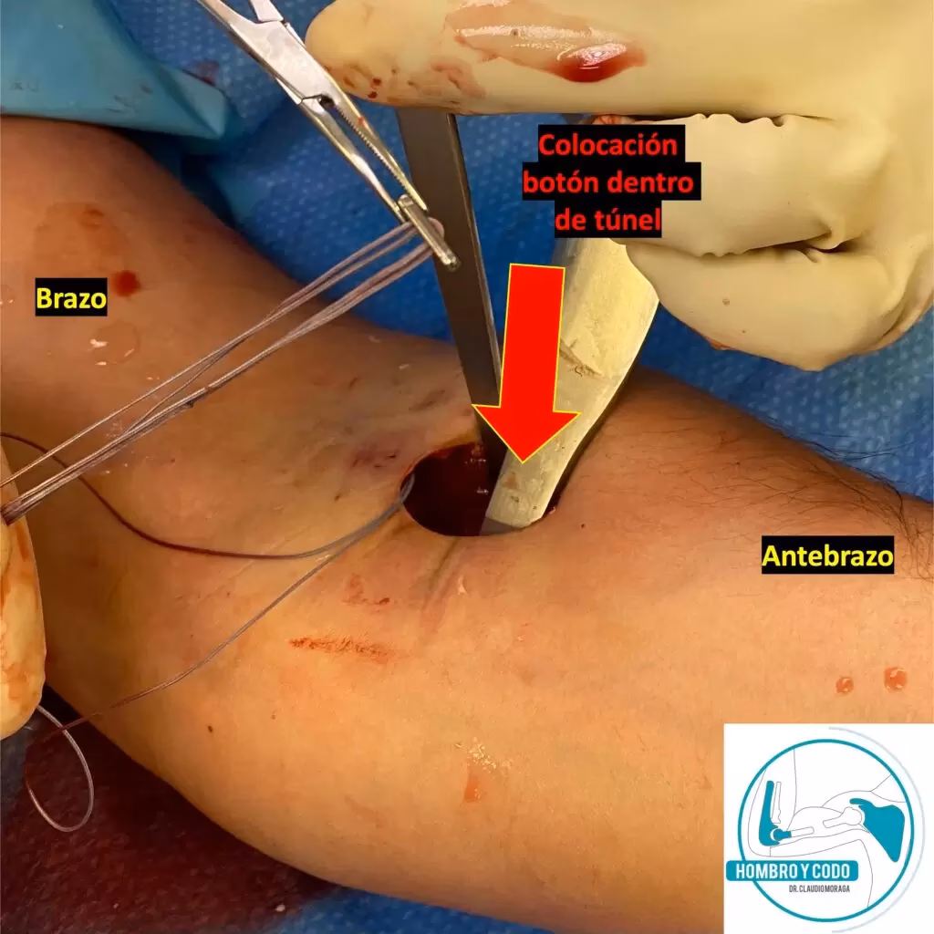 ¿Cuánto dura una operación de tendón de bíceps?