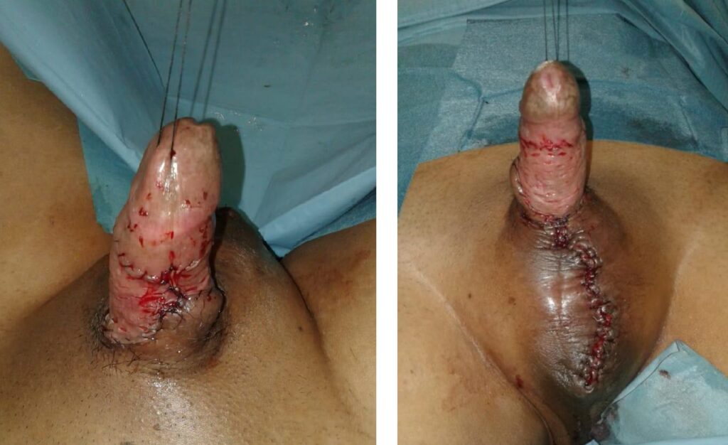 Circuncisión: Guía Completa de Beneficios y Riesgos