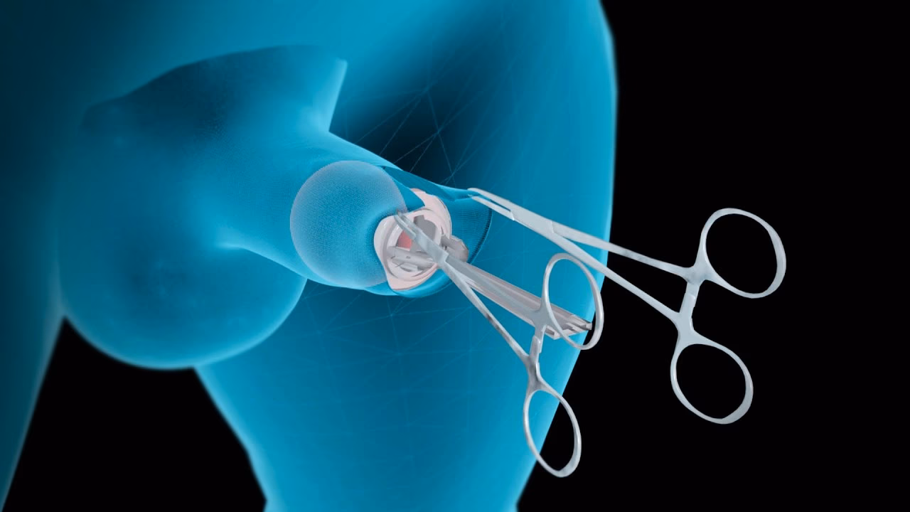 ¿Qué no se puede hacer después de una circuncisión?