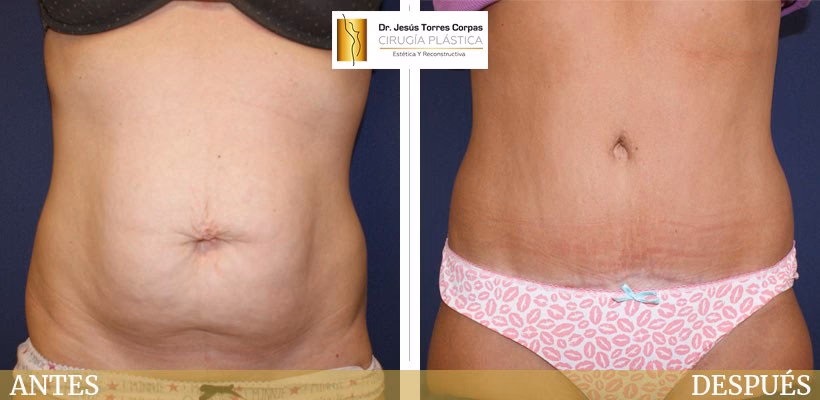 ¿Qué ocurre si te sometes a una cirugía plástica durante el embarazo?