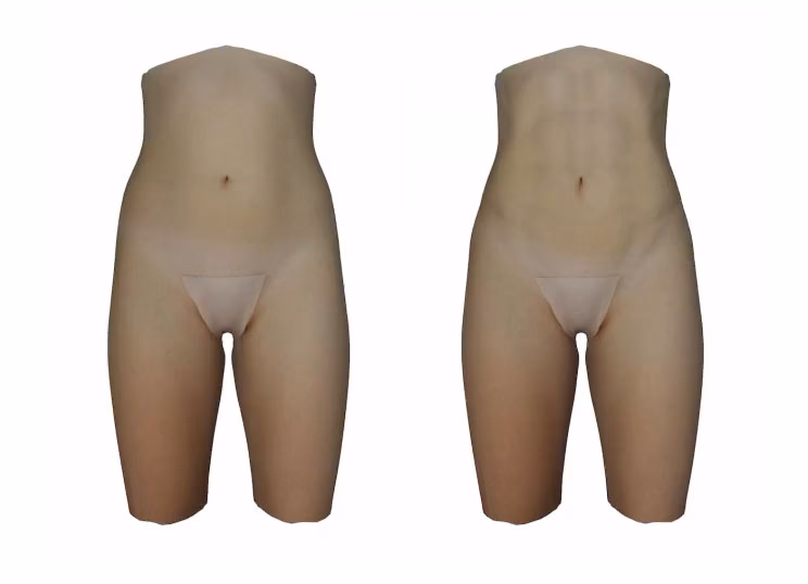 ¿Cuánto cuesta la liposucción en Australia?