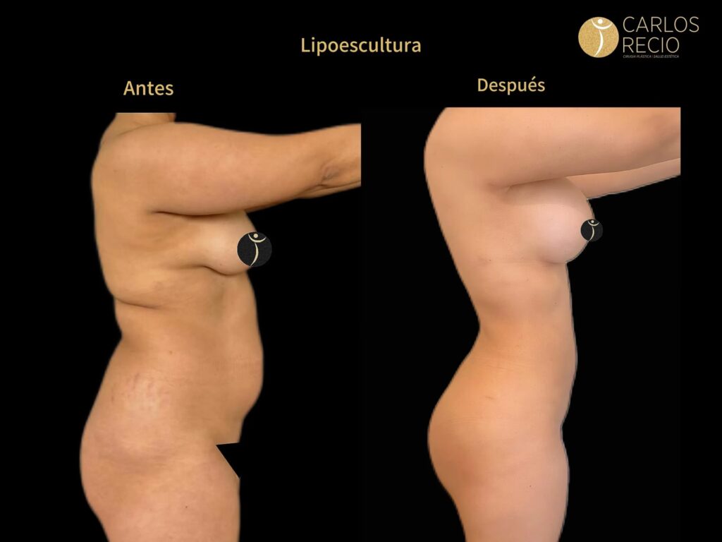 Precio de Lipoescultura en Cali: Guía Completa