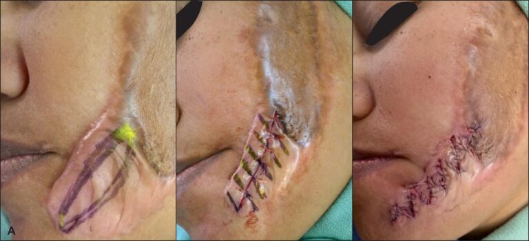 Cirugía de Cicatrices: ¿Es Posible Borrarlas?