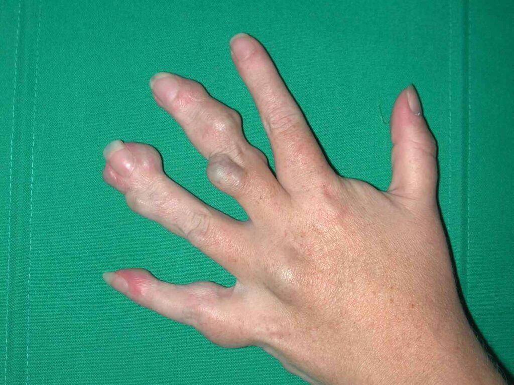 Cirugía Plástica de Dedos: Guía Completa