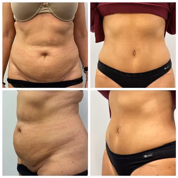 ¿Cuánto tarda en sanar una cirugía en el abdomen?