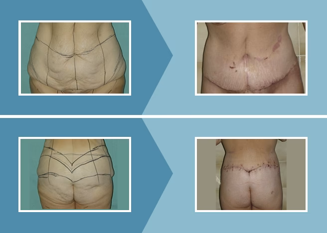 ¿Cuánto cuesta una cirugía plástica de abdomen?