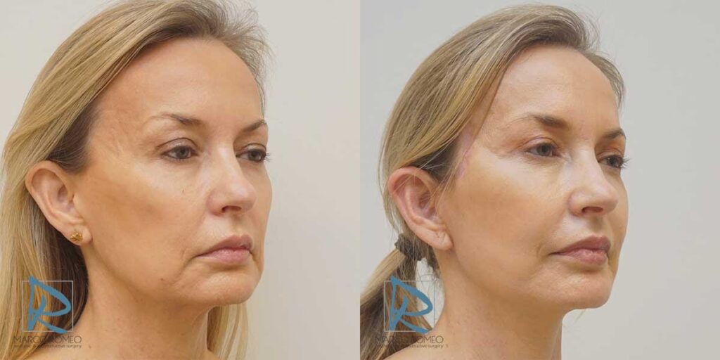 Perfilamiento Facial: Costo y Procedimiento