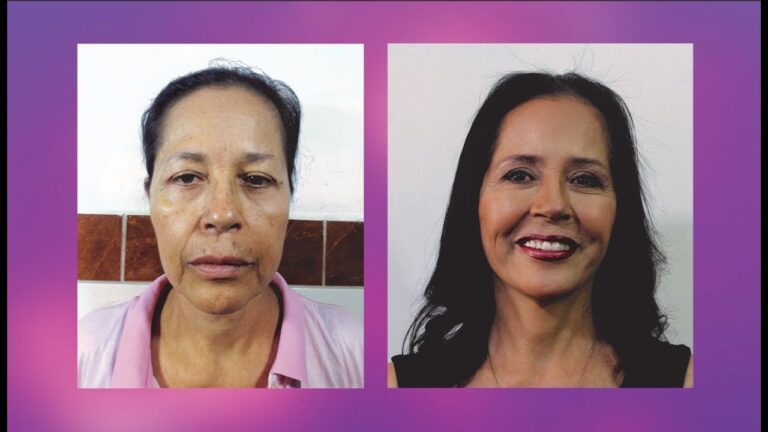 ¿Hay una edad límite para la cirugía plástica?