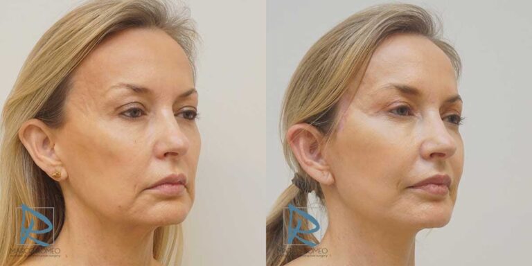 Perfilamiento Facial: Costo y Procedimiento