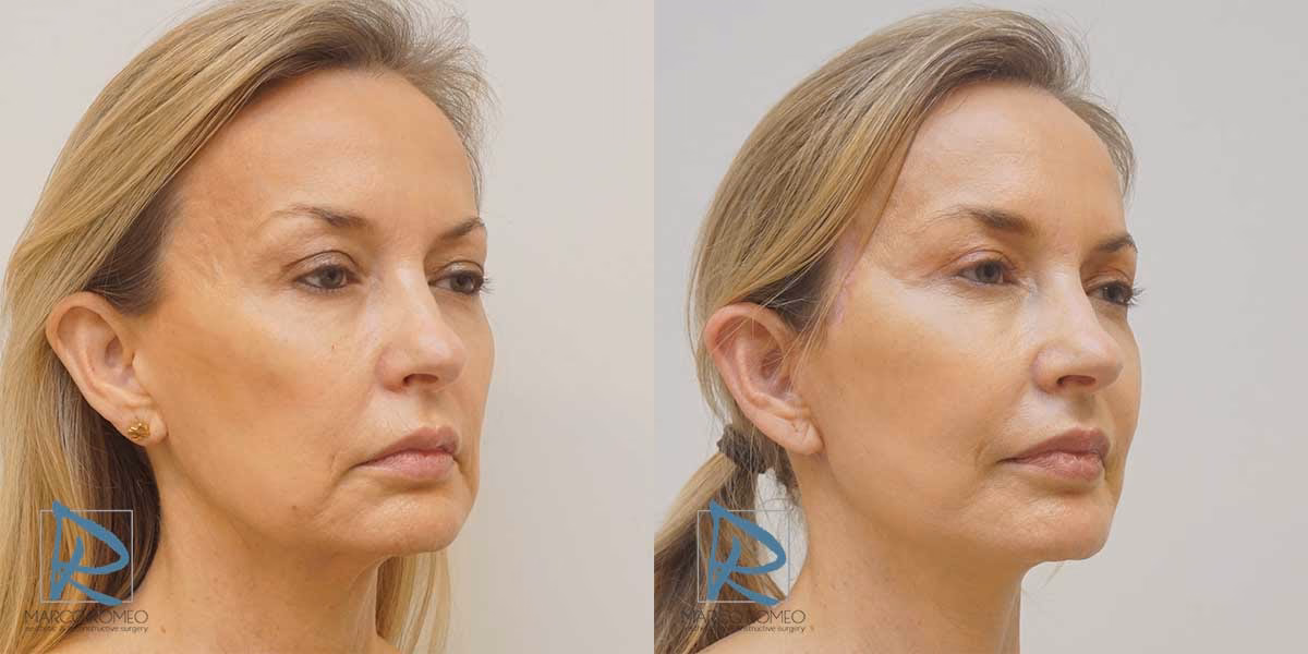 ¿Cuánto cuesta una cirugía plástica del rostro?