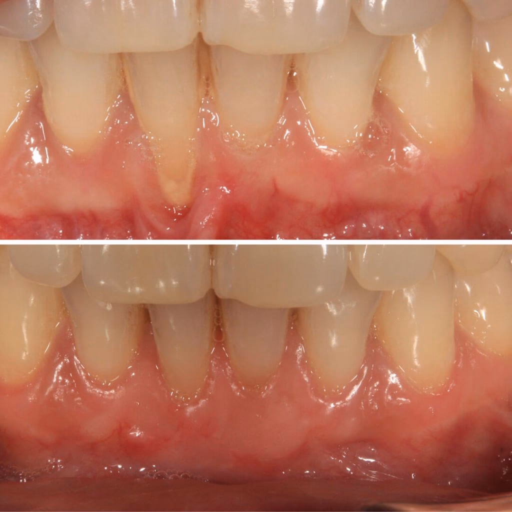¿Qué tan riesgosa es la cirugía ortognática?