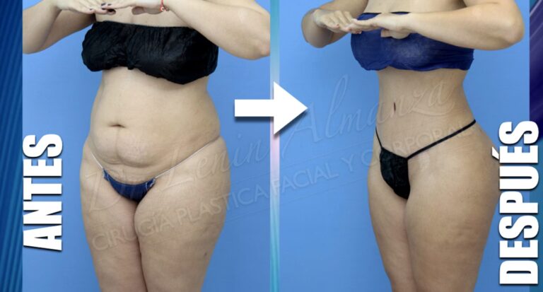 Cirugía Plástica en Panamá: Costos y Calidad