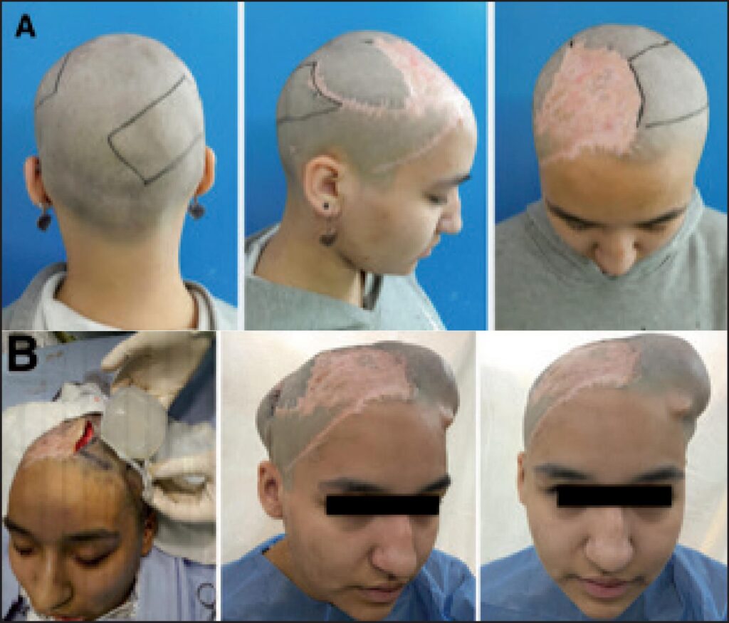 Cirugía Craneofacial: Reconstruyendo Vidas