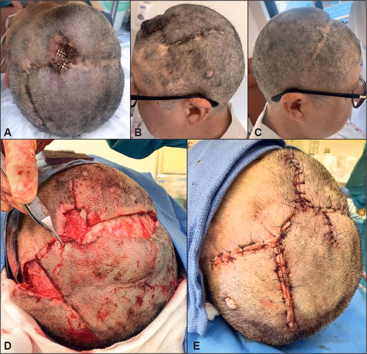 ¿Qué es una cirugía plástica en la cabeza?