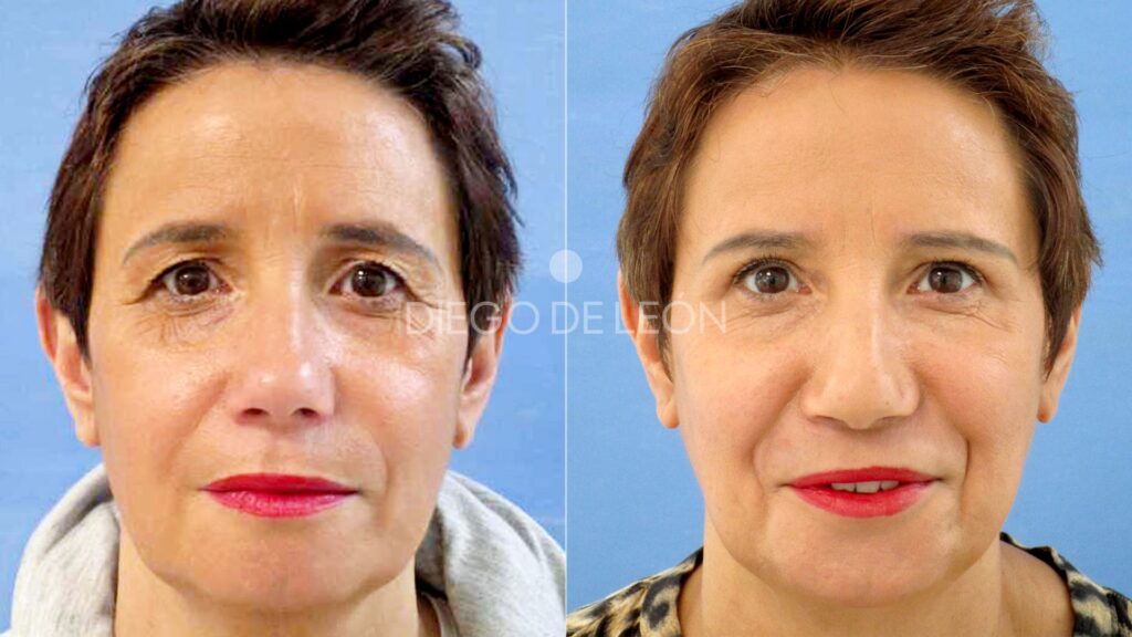 Blefaroplastia: ¿Vale la Pena la Inversión?