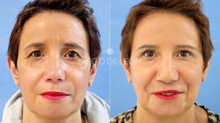Blefaroplastia: Guía de Precios y Cobertura