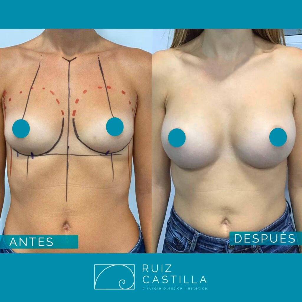 ¿Qué tan riesgosa es una cirugía de aumento de senos?