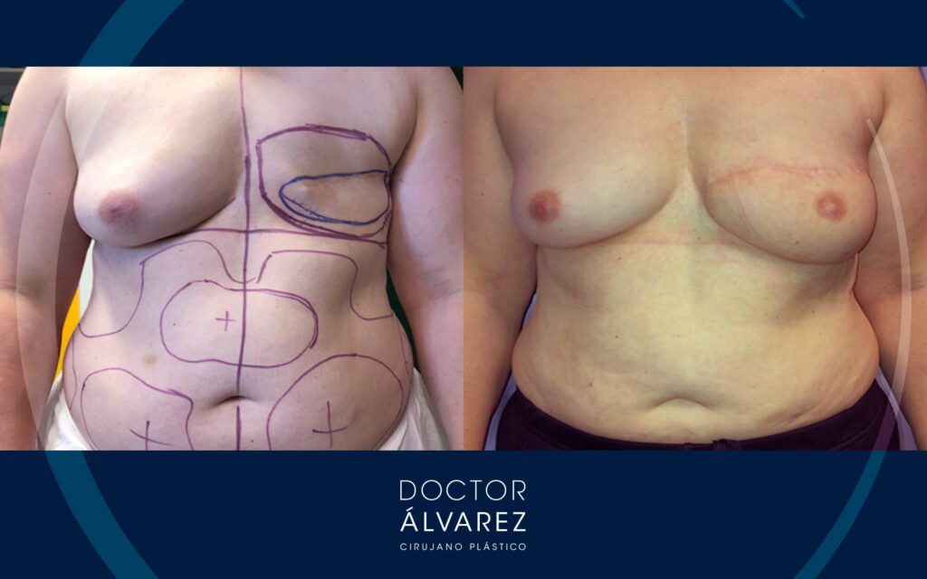 Costo de Cirugía de Pechos: Guía Completa 2024