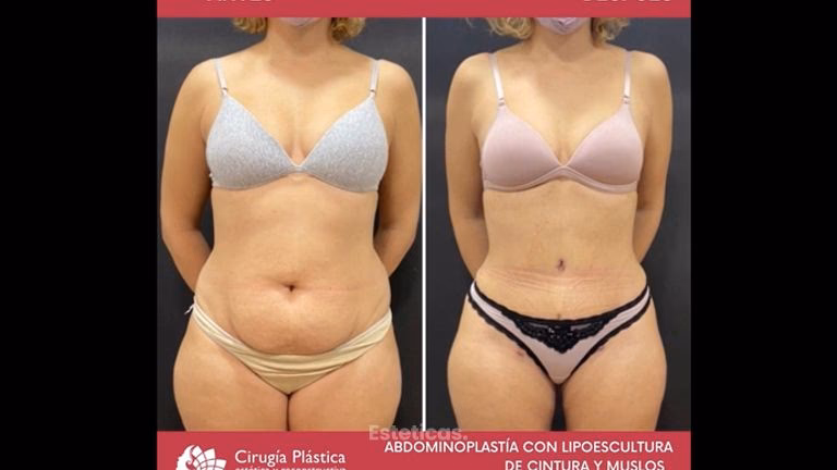 ¿Quiénes son algunos cirujanos plásticos recomendados en Santiago?