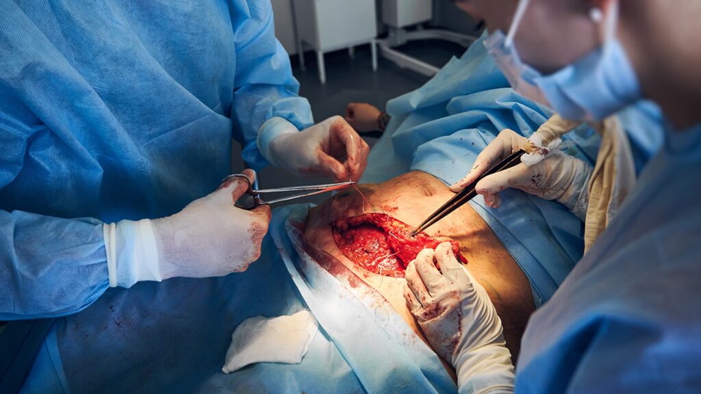 Recuperación de Cirugía Torácica: Guía Completa