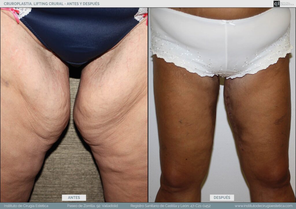 Lifting de Muslos: Guía de Costos, Tipos y Recuperación