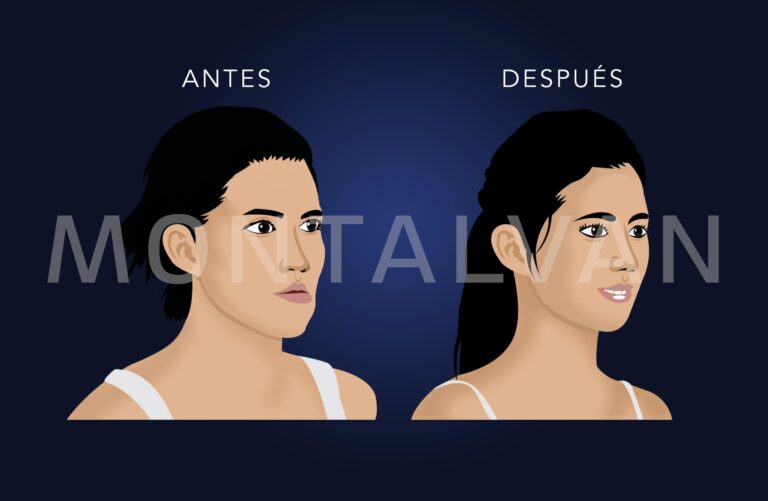 Cirugía para Adelgazar el Rostro: Guía Completa