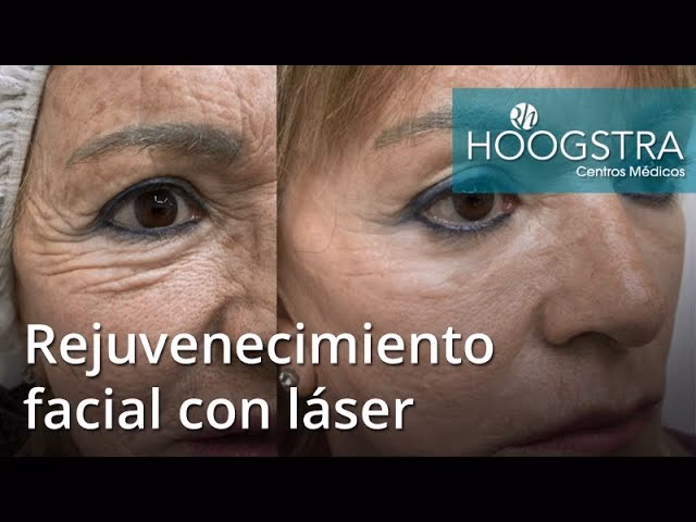 ¿Cuánto dura el efecto de láser en la cara?