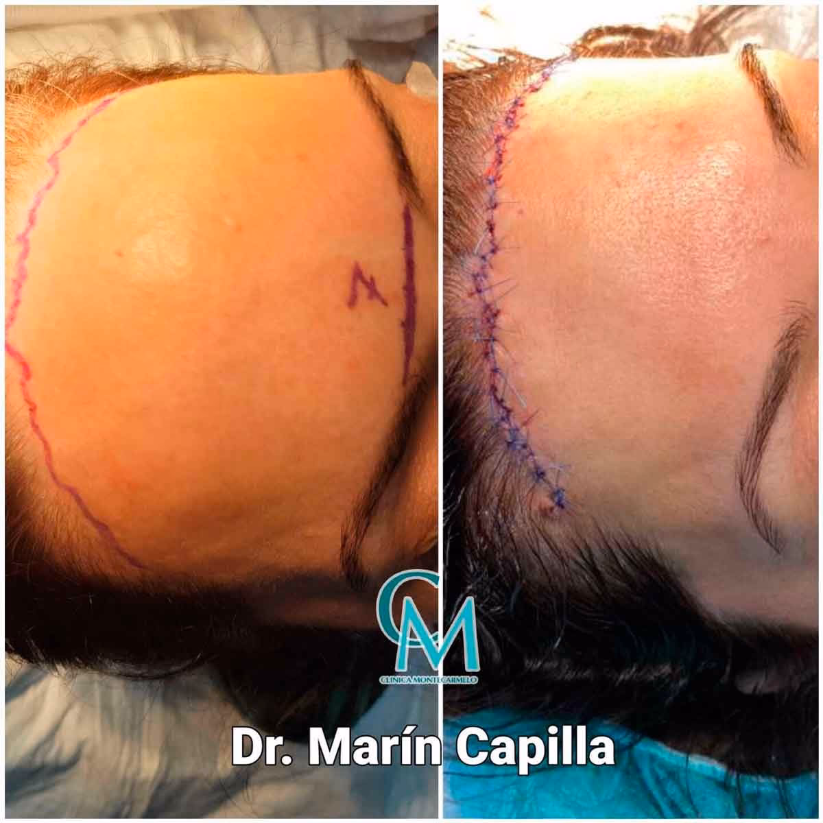 ¿Qué puedo hacer para reducir el tamaño de mi frente?