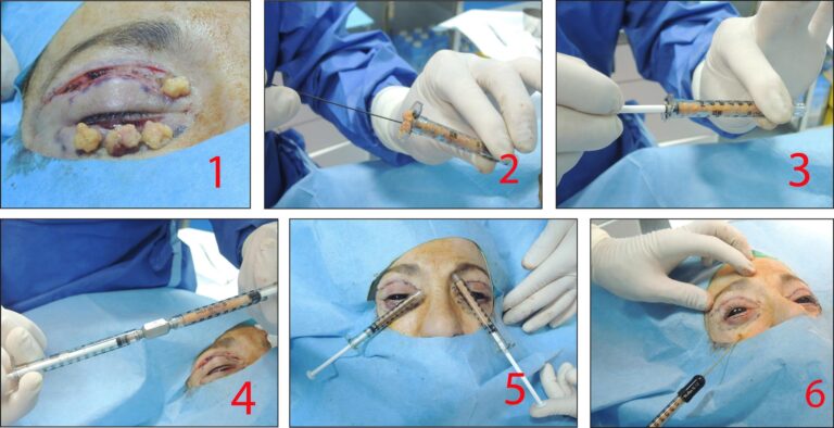 Punta Nasal Bífida: ¿Qué es y cómo se corrige?