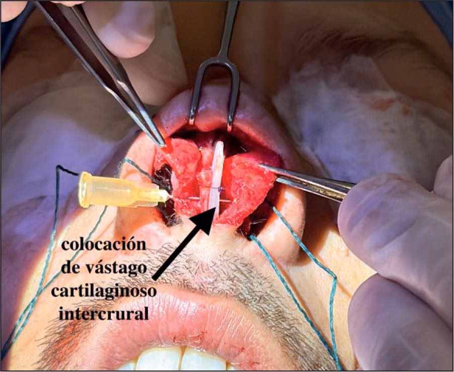 ¿Qué es una TAC de huesos propios de la nariz?