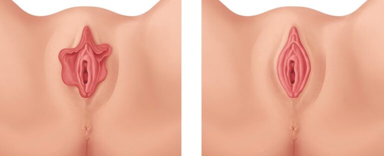 Cirugía Ginecológica: Salud y Estética Íntima