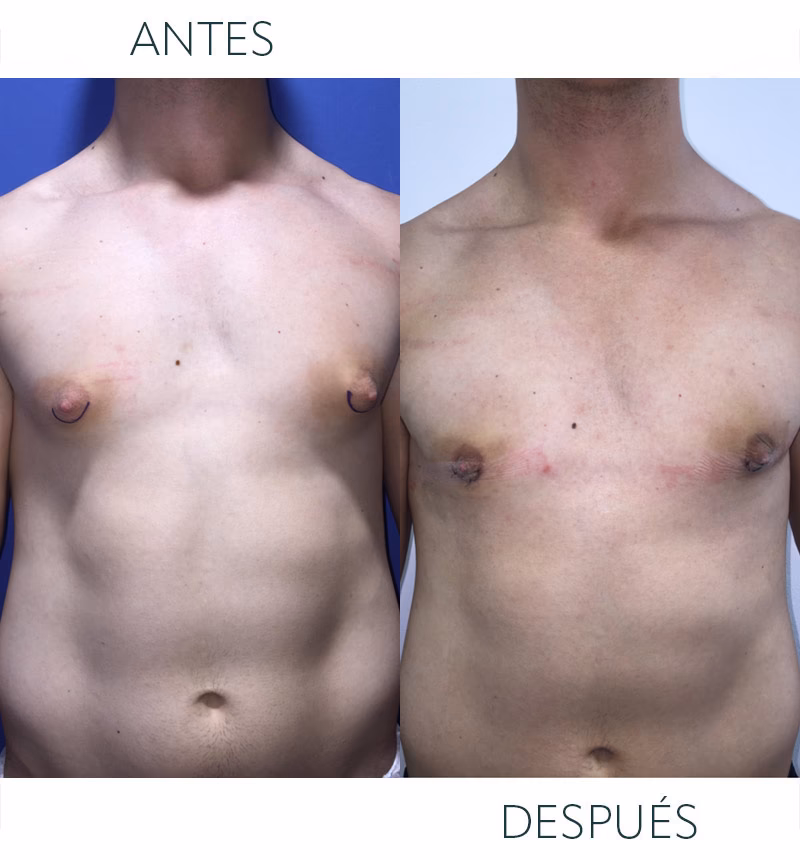 ¿Cuánto vale una operación para quitar la ginecomastia?