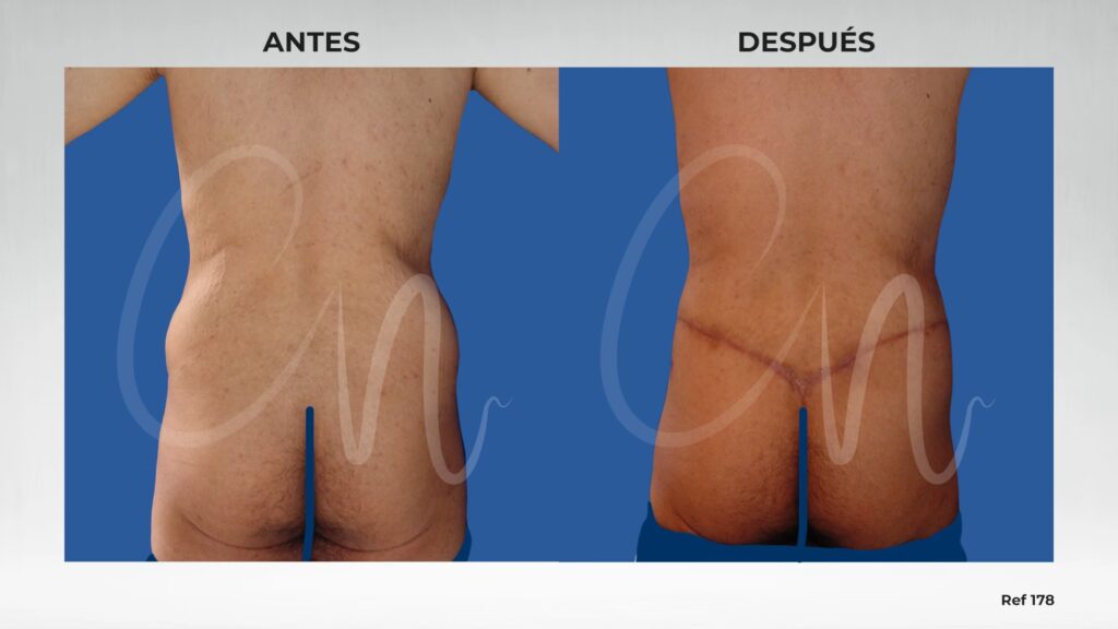 Glúteo Max en Colombia: ¿Qué es y cómo funciona?