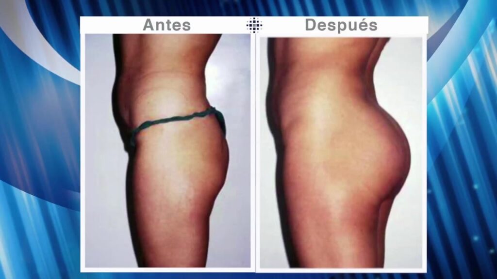 BBL Masculino: ¿Vale la pena esta cirugía estética?