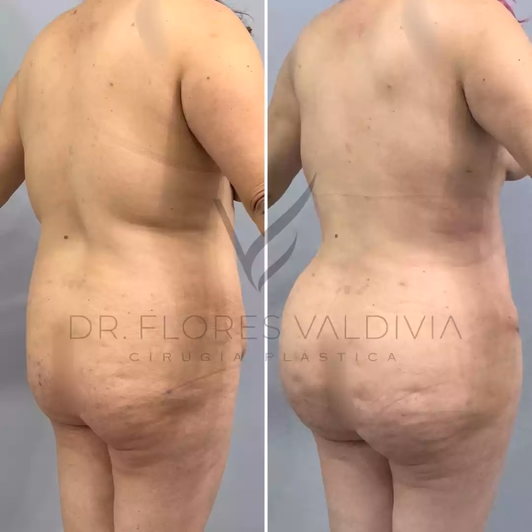 ¿Qué riesgos tiene la transferencia de grasa a los glúteos?