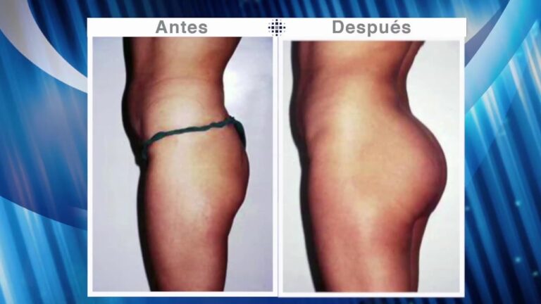 BBL Masculino: ¿Vale la pena esta cirugía estética?