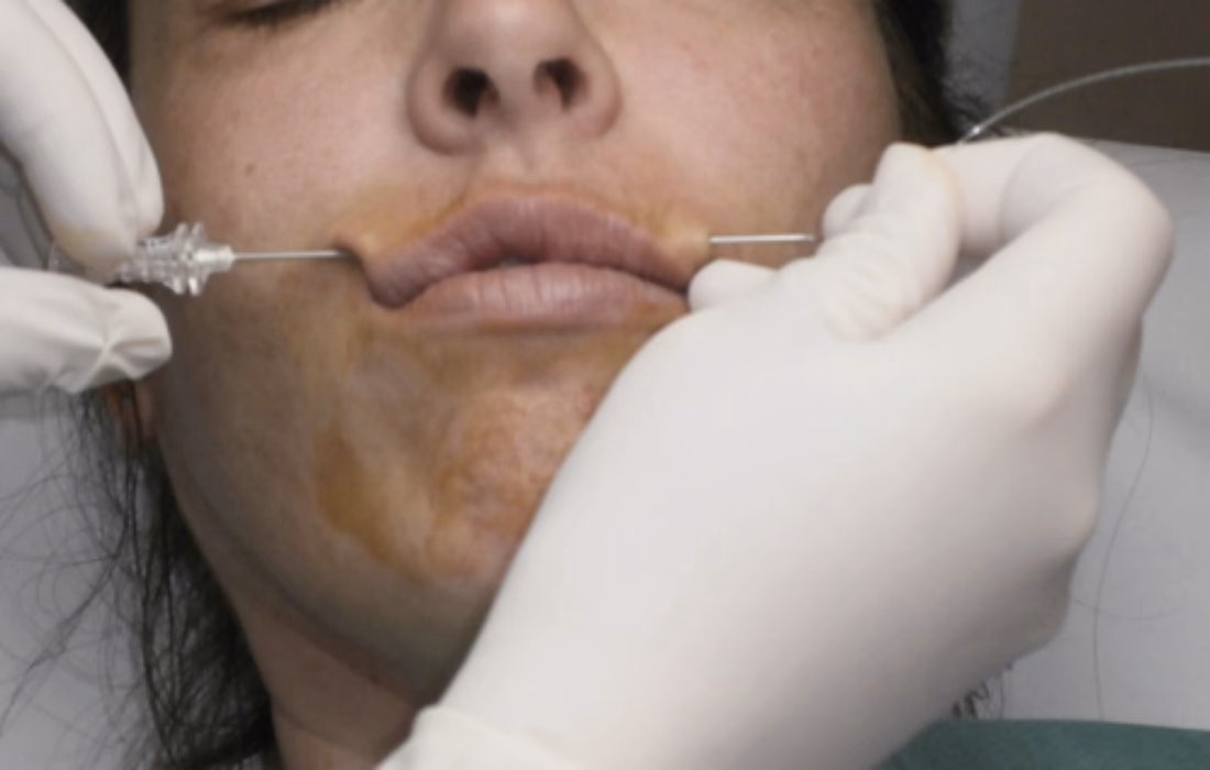 ¿Cuánto tiempo duran los hilos de oro?