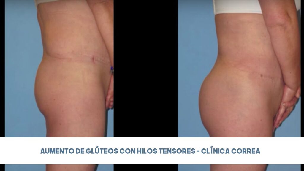 Hilos Tensores en Glúteos: El Lifting sin Cirugía