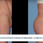 Hilos Tensores en Glúteos: El Lifting sin Cirugía