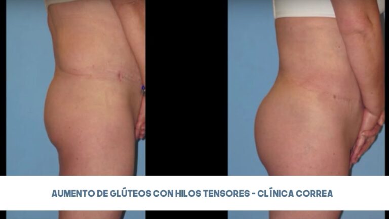 Hilos Tensores en Glúteos: El Lifting sin Cirugía