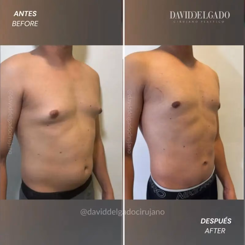 ¿Cómo eliminar los senos masculinos sin cirugía?