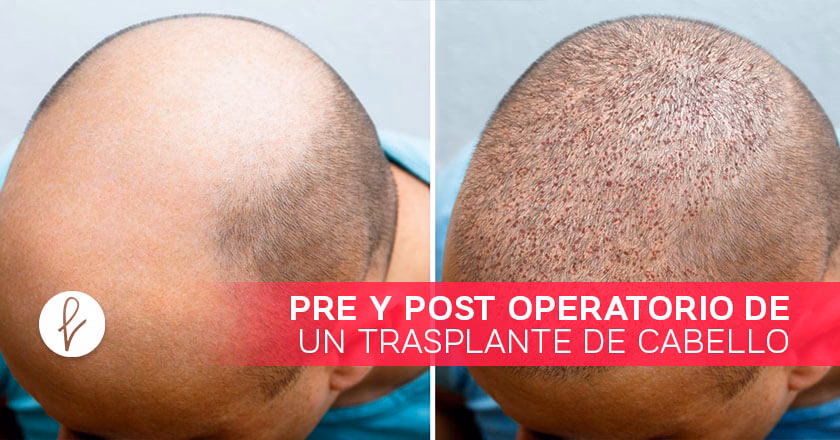 Injerto Capilar: Guía Completa y Duración