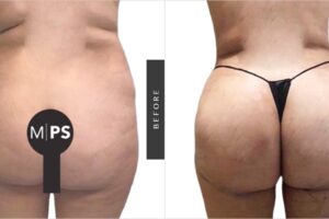 Precio de un Lifting de Cuello en Chile: Guía 2024